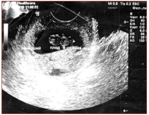 Рис. 2. Замершая после введения метотрексата шеечная беременность. Трансвагинальное УЗИ.