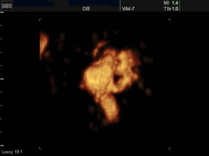 Рис. 17. Беременность 32 недели (2D сканирование в сагиттальной плоско- сти мозга с режимом энергетического допплера). Аневризма вены Галена. Визуализируются фрагменты ано- мальной сосудистой системы голов- ного мозга плода.