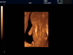 Рис. 5. Беременность 11-12 недель (поверхност- ный 3D/4D режим). Spina bifida в шейном, грудном и поясничном отделах.
