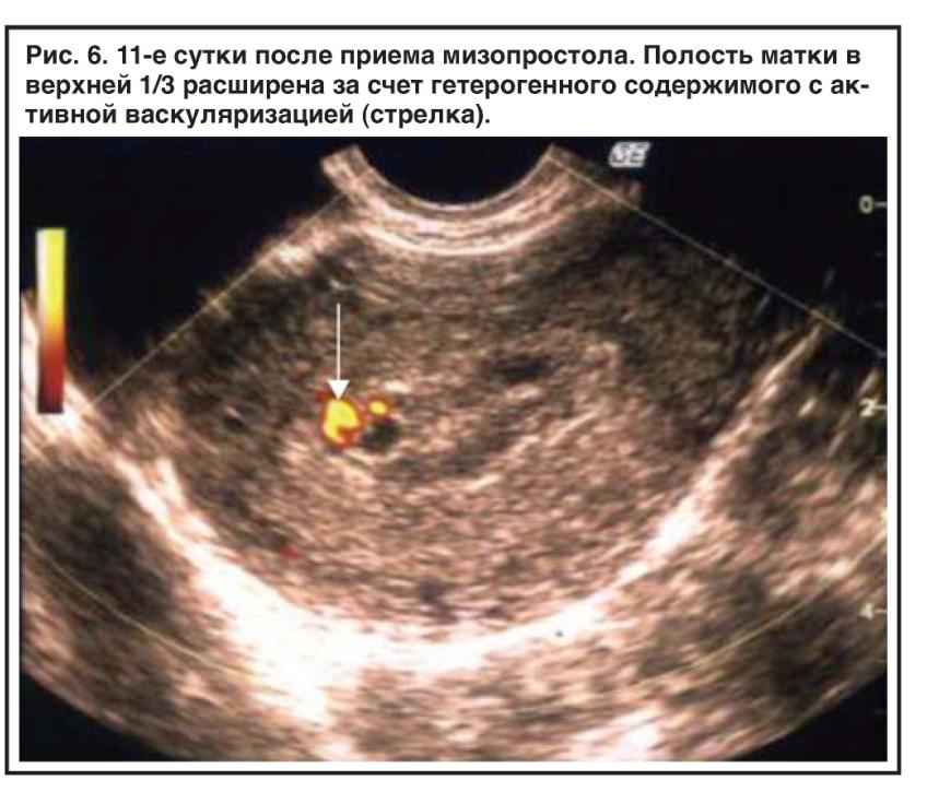 Эндометрий 4 3. Плодное яйцо 5 недель медикаментозное прерывание. Замершая беременность УЗИ. Неполный медикаментозный аборт. УЗИ после медикаментозного аборта.