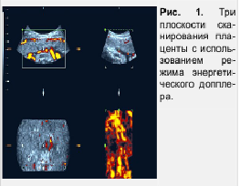 Рис. 1. Три плоскости сканирования плаценты с использованием режима энергетического допплера