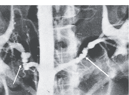 Рис. 7. Данные аортографии больной М., 24 года: множе-ственные двусторонние стенозы почечных артерий при фибромышечной дисплазии — «жемчужное ожерелье» или «четки»