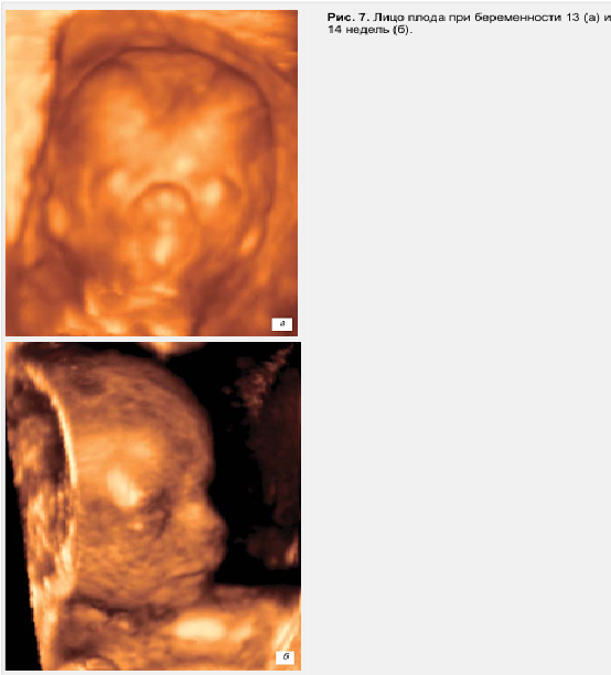 Рис. 7. Лицо плода при беременности 13-14 неделя