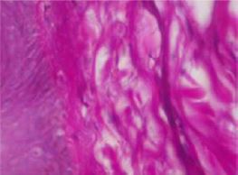 Рис. 4. больная Р., очаговая распространенная склеродермия, подострая стадия. в сетчатом слое обнаруживаются потовые железы, окруженные широкими кольцевидными разрастаниями соединительной ткани. окраска гематоксилином и эозином. х400.