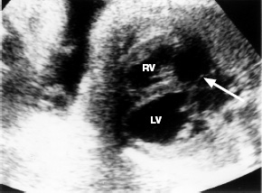 Рис. 6. Четырехкамерное сечение сердца плода. Фиброэластическая форма кардиомиопатии. По­лость левого желудочка (LV) увеличена и имеет округлую форму, стенки уплотнены. Овальное окно не функционирует (стрелка); RV- правый желудочек. 