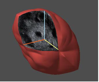 Поликистозный яичник. 3Д режим, режим Vocal. Измерение объема яичника, объем увеличен (18 см3)