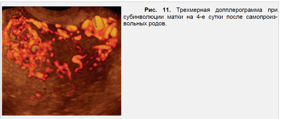 Трехмерная допплерограмма при субинволюции матки на 4-е сутки после самопроизвольных родов.
