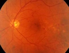 ретинопатия-2