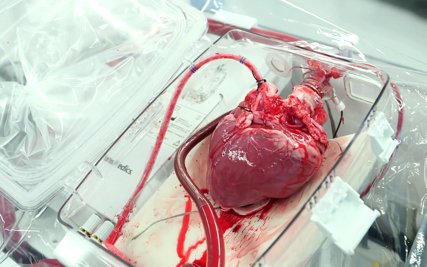 Благодаря аппарату “сердце в коробке” не происходит отмирание клеток, так как кровь вместе с кислородом постоянно циркулирует в нем