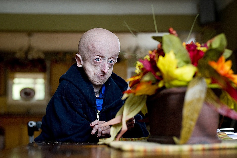progeriya