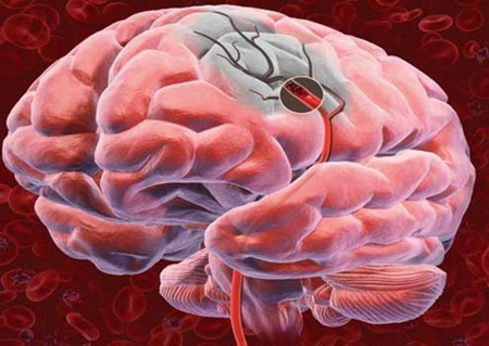 Ишемический инсульт (ИИ) – острое нарушение мозгового кровообращения вследствие нарушения кровотока в головном мозге