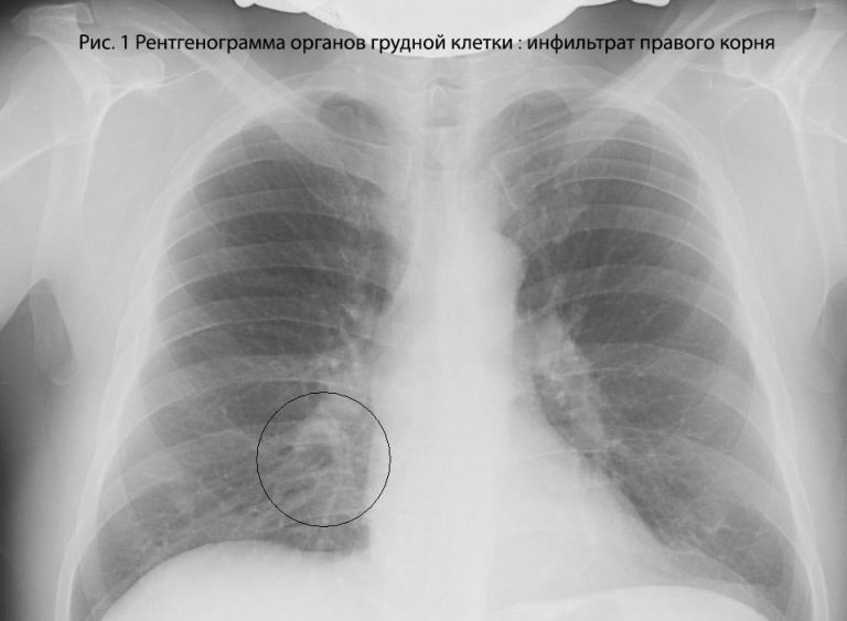 Двухсторонняя пневмония карта вызова