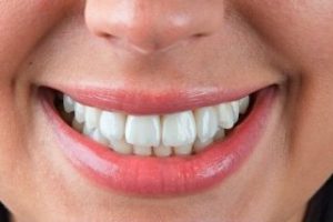 Зубні імпланти - МедПросвіта