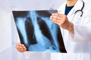Ведення пацієнтів з туберкульозом на амбулаторному етапі лікування для лікарів первинної медичної допомоги